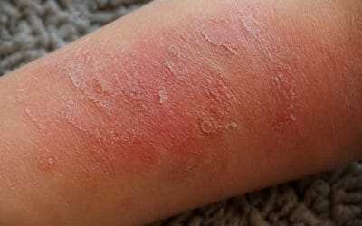 Dermatita atopică: de ce apare și cum gestionezi corect mâncărimea intensă