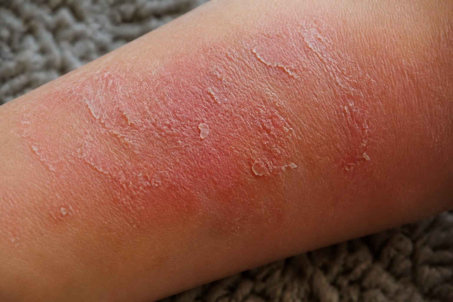 Dermatita atopică: de ce apare și cum gestionezi corect mâncărimea intensă